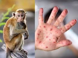 Be careful about monkeypox, – Citizens should not panic about monkeypox